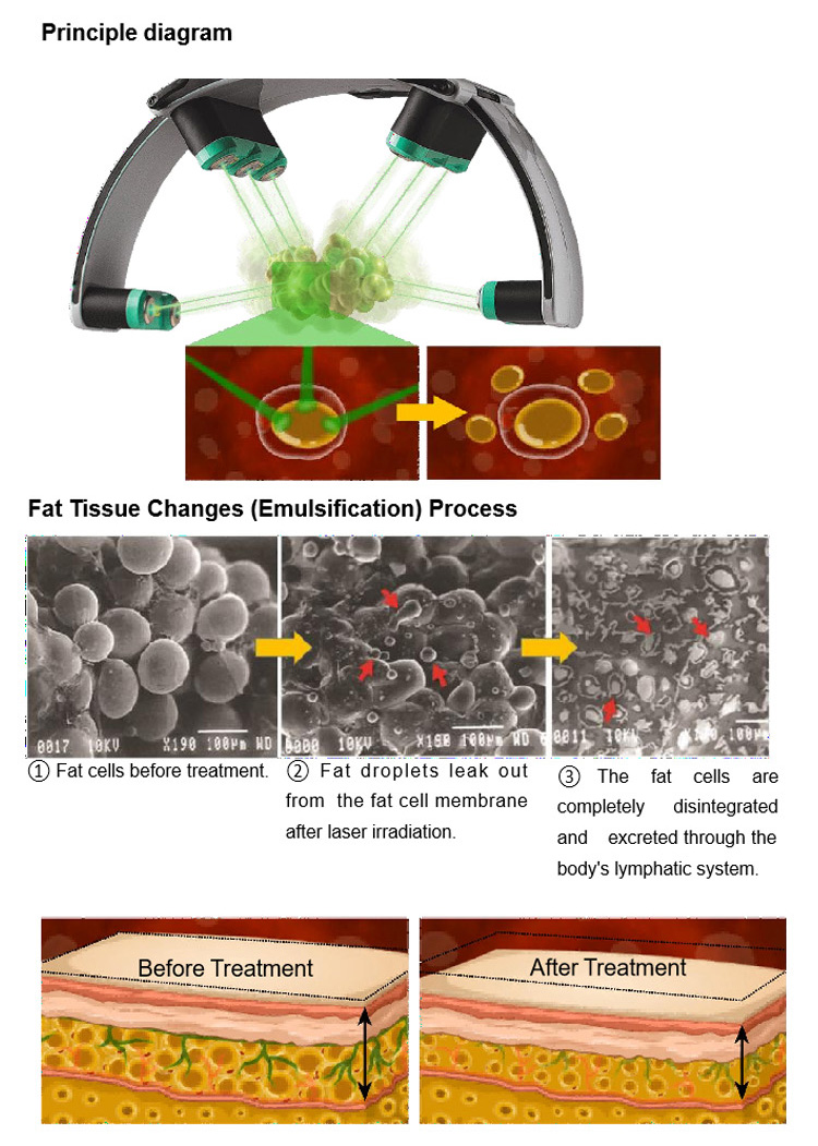 lipo laser weight loss slmming machine